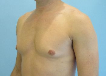 Gynecomastia Before & After case 6