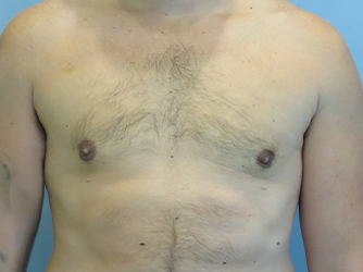 Gynecomastia Before & After case 8