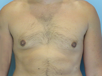 Gynecomastia Before & After case 8