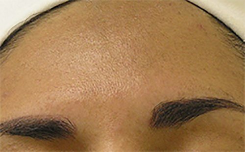 Hydrafacial Before & After case 1