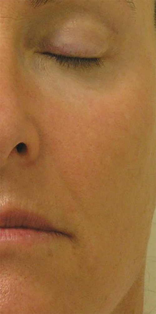 Hydrafacial Before & After case 3