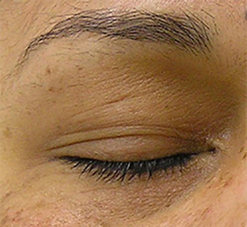 Hydrafacial Before & After case 4