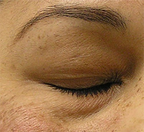 Hydrafacial Before & After case 4