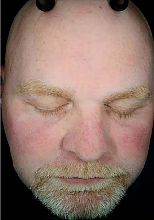 Hydrafacial Before & After case 6