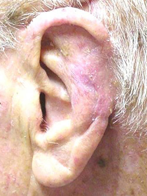 Skin Cancer Before & After case 3