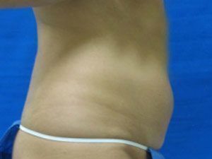 Smart Liposuction Before & After case 10