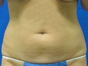 Smart Liposuction Before & After case 10