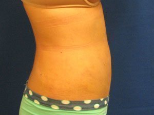 Smart Liposuction Before & After case 11