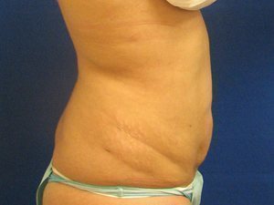 Smart Liposuction Before & After case 12