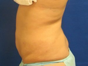 Smart Liposuction Before & After case 12