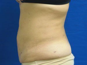Smart Liposuction Before & After case 13