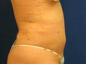 Smart Liposuction Before & After case 15