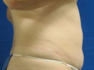 Smart Liposuction Before & After case 17