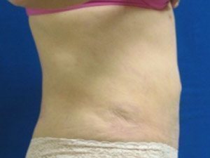 Smart Liposuction Before & After case 17