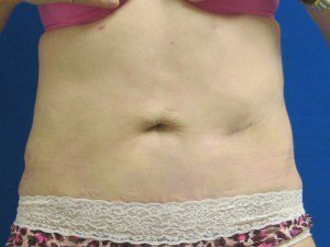Smart Liposuction Before & After case 17