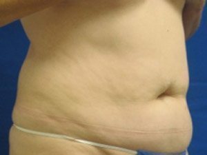 Smart Liposuction Before & After case 17