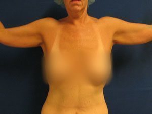 Smart Liposuction Before & After case 18