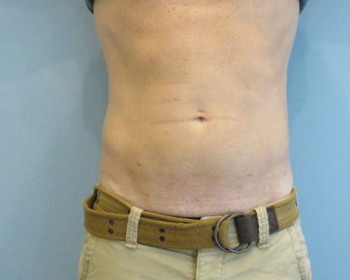 Smart Liposuction Before & After case 1