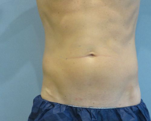Smart Liposuction Before & After case 1