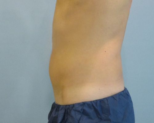 Smart Liposuction Before & After case 1