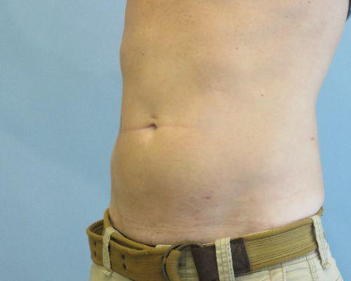 Smart Liposuction Before & After case 1