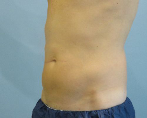 Smart Liposuction Before & After case 1