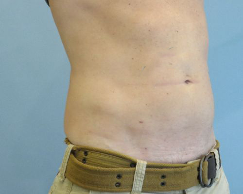Smart Liposuction Before & After case 2