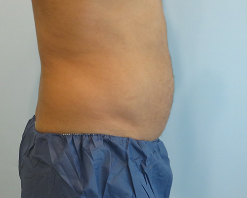 Smart Liposuction Before & After case 2