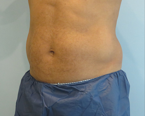 Smart Liposuction Before & After case 2