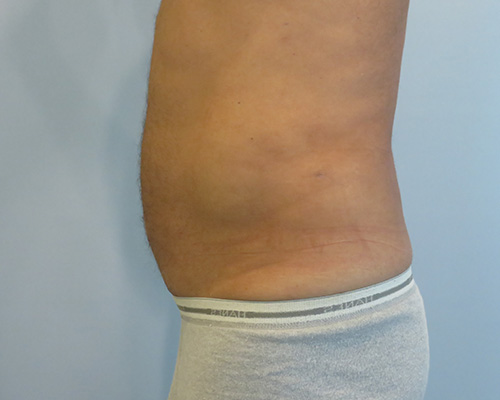Smart Liposuction Before & After case 2