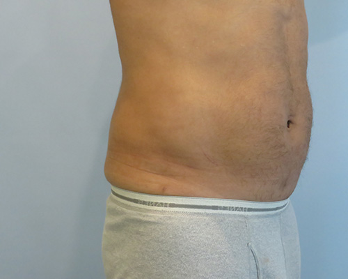 Smart Liposuction Before & After case 2