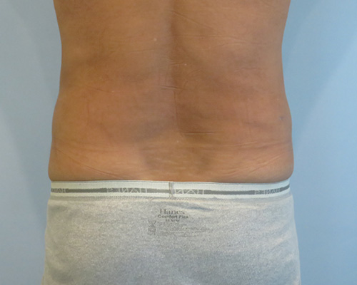 Smart Liposuction Before & After case 2
