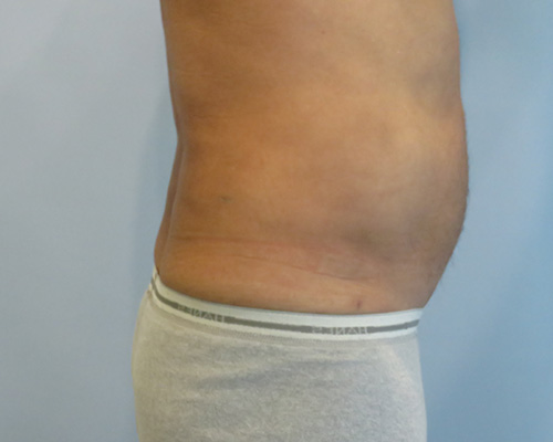 Smart Liposuction Before & After case 2