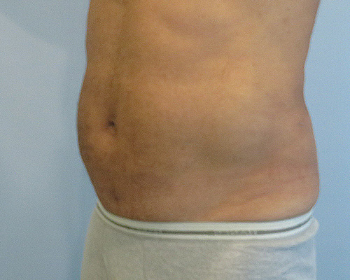 Smart Liposuction Before & After case 2