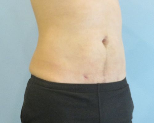 Smart Liposuction Before & After case 3