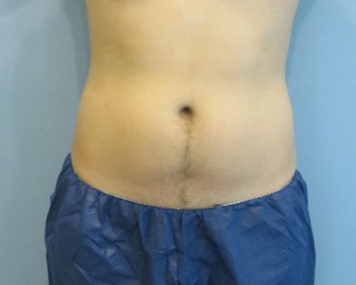 Smart Liposuction Before & After case 3