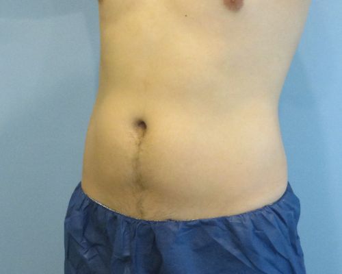 Smart Liposuction Before & After case 3