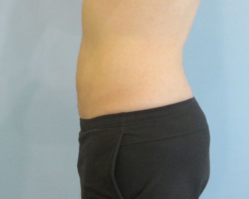 Smart Liposuction Before & After case 3