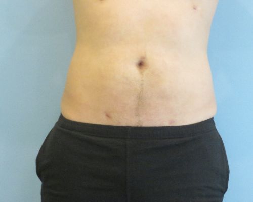 Smart Liposuction Before & After case 3