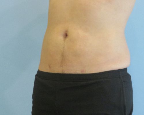 Smart Liposuction Before & After case 3
