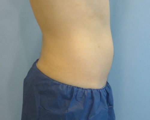 Smart Liposuction Before & After case 3