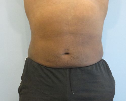 Smart Liposuction Before & After Case 4
