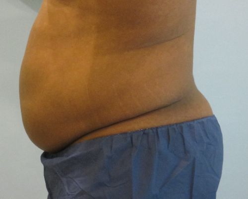 Smart Liposuction Before & After Case 4