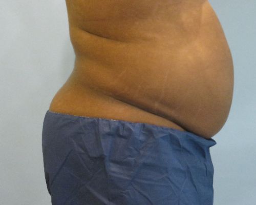 Smart Liposuction Before & After Case 4