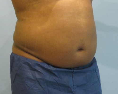 Smart Liposuction Before & After Case 4
