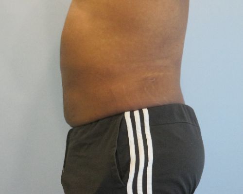 Smart Liposuction Before & After Case 4