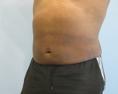 Smart Liposuction Before & After Case 4