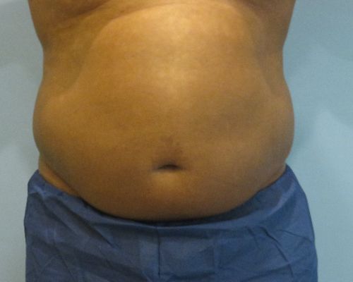 Smart Liposuction Before & After Case 4