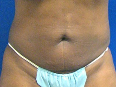 Smart Liposuction Before & After case 6