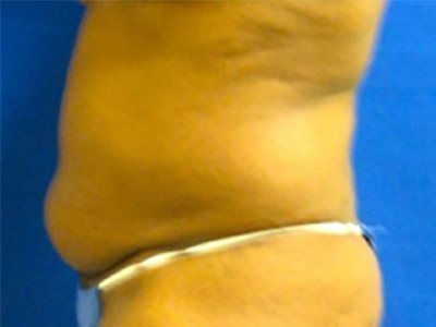 Smart Liposuction Before & After case 6